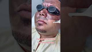 Carbon Laser ￼Facial getsmarthairclub skintreatment shorts shortvideo shortsfeed [upl. by Kevan]