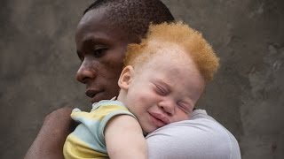 CO anglais baccalauréat African albinos being killed for organs [upl. by Ronoc635]