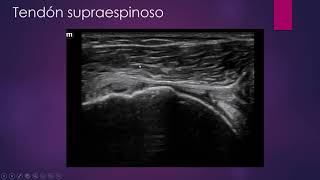 ROTURA CRONICA DEL TENDON SUPRAESPINOSO DE ANCHURA TOTAL [upl. by Mahgem]