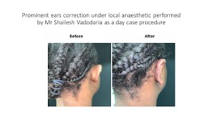 Patients experience of undergoing Otoplasty Prominent ear correction at MACS Clinic [upl. by Arednaxela817]