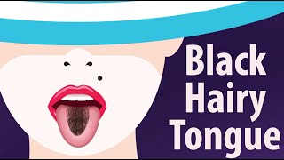 Black Hairy Tongue Causes and Treatment [upl. by Allesig172]