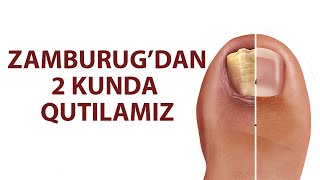 Uy Sharoitida Oyoq Zamburugidan Qutulish Usuli [upl. by Iralam]