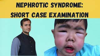 NEPHROTIC SYNDROME Practical approach to short case examination [upl. by Poyssick]