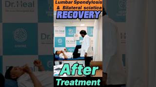 Lumbar Spondylosis amp Bilateral Sciatica Recovery After Treatment yt ad viralvideo reachout [upl. by Harbert]