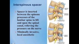 Symptoms of Spinal Stenosis [upl. by Anstus]