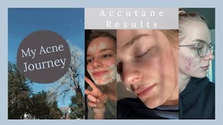 Accutane RESULTS  2040mg LOW DOSE [upl. by Euqininod463]