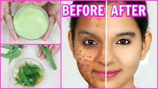 Remove Pimples Permanently 100 Results  DIY Face Wash Spot Treatment  Anaysa [upl. by Atiuqes]