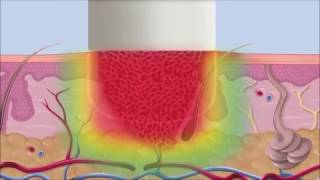 Swift Verruca Microwave Treatment Process [upl. by Parshall]