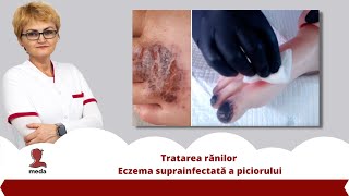 Tratarea ranilor 👉 Eczema suprainfectata a piciorului [upl. by Jentoft]