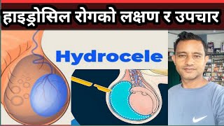 Hydrocele details in Nepali हाइड्रोसिल कसरी हुन्छ यसको लक्षण तथा औषधि उपचार कसरी गर्ने [upl. by Hailahk]