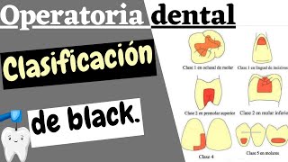 CLASIFICACIÓN DE LAS CAVIDADES DENTALES SEGUN BLACK  CARIES DENTAL EXPLICADA FACIL [upl. by Piers583]