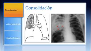 Patrones Pulmonares en Radiología y TC [upl. by Tish]