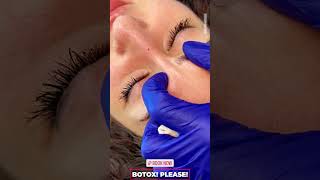 Botox Injections for Frown Lines Glabellar in Dubai  Reduce Wrinkles amp Fine Lines [upl. by Grimes898]