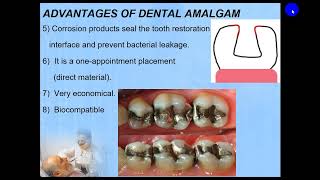 Dental Amalgam Part 1 [upl. by Cresida152]