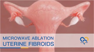 Microwave Ablation of Uterine Fibroids  Animation [upl. by Nniroc996]