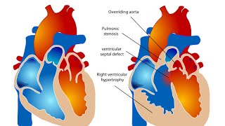 Tetralogy of Fallot [upl. by Kayle204]