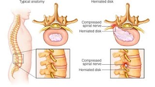 Back pain kamar Dard L4 L5 L5 S1 disc mein problem thi vah Dr AP GAUTAM physiotherapy se thik kardi [upl. by Anelat467]