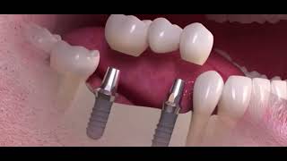 Le BRIDGE sur IMPLANTS dentaires  le pont dentaire sur implants [upl. by Yolane]