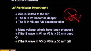 1215 Lead ECG Ventricular Hypertrophy [upl. by Brine]