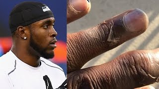 Kam Chancellor’s Frostbitten Fingers Look CRAZY [upl. by Symons]