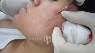 Subcision for Acne Scars  Acne Scar Treatment  Cheek Acne Scar Removal  Dr Jason Emer [upl. by Darej]