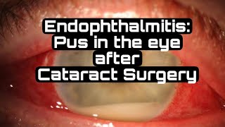 What is ENDOPHTHALMITIS Eye Infection endophthalmitis [upl. by Litta304]