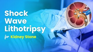 Shock Wave Lithotripsy ESWL for Kidney Stone Treatment  3D Guide [upl. by Ingraham]