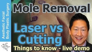 Laser vs Excision Cutting Face Mole Removal Discussion amp Live Surgery Seattle Bellevues Dr Young [upl. by Anilat]