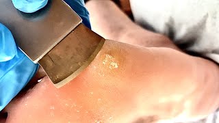 Callus removal from feetampFoot scraping dead skin【Xiao Yan pedicure】stress 77 [upl. by Wilburt]