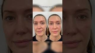 TEAR TROUGH FILLER RESULTS  DR MEDISPA [upl. by Nomit]