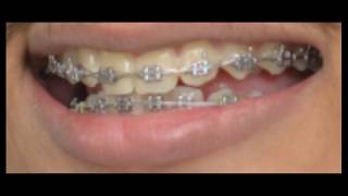 braces time lapse orthodontic treatment [upl. by Ecnerat]