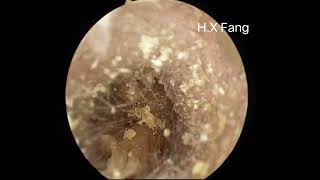 Easy earwax removal简单的耳屎清理20230824 [upl. by Leid629]