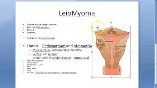 Pathology 721 a Leiomyoma FIBROID uterus fibromyoma Smooth muscle benign Gross specimen Practical [upl. by Annawek]