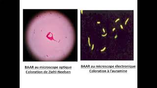 06Tuberculose extrapulmonaire TEP Pr Yahaoui Beni Messousse  Pneumo [upl. by Nisen883]