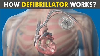 How Defibrillator Works Automated External Defibrillation working mechanism [upl. by Airdnoed]