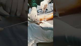 Cruciate ligament repair ligament surgery  mozart peroneus longus [upl. by Tice]