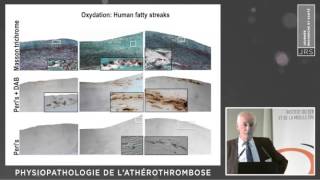 Physiopathologie de l’athérothrombose JB MICHEL [upl. by Bartolemo]