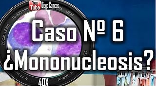 caso clinico Nº 6  Mononucleosis infecciosa [upl. by Francie]