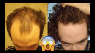 ANTES E DEPOIS  MINOXIDIL  FINASTERID4  15 MESES  CABELO [upl. by Seftton]