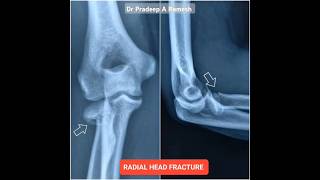 Radial Head Fracture  Minimally Invasive Surgery with Retrograde TENS Nail Fixation [upl. by Willette544]