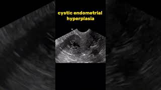 Cystic endometrial hyperplasia ultrasound radiologysonology [upl. by Epotimet269]