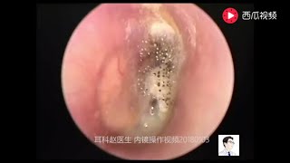 Earwax Removal ExtractionCerumen airtight 13 minutes [upl. by Abbotson]