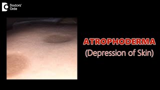 Atrophoderma is curable or not  Depression of Skin  What is this DrNischal K  Doctors Circle [upl. by Lynette396]