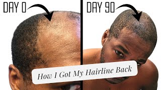 Microneedling for a Receding Hairline  Unedited Progress Pics [upl. by Ranite77]