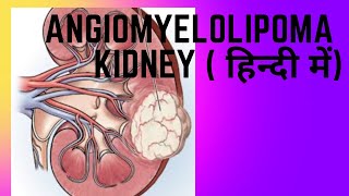 Angiomyelolipoma AML of kidney  एंजियोमायोलिपोमा एएमएल किडनी [upl. by Osnerol124]