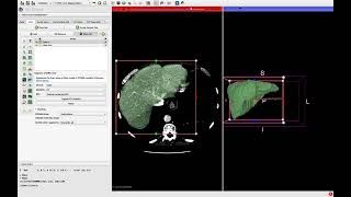 Réaliser gratuitement une volumétrie hépatique à laide du logiciel 3D Slicer [upl. by Desirae]