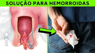 Como Curar Hemorroida Em 2 Dias  Tratamento Caseiro Para Hemorroida  Sintomas HEMORROIDA INFLAMADA [upl. by Anotyal]