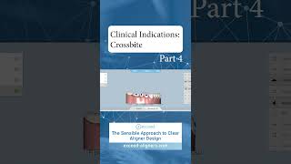 Clinical Indications Crossbite Part 4 [upl. by Sikes246]