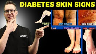 EARLY WARNING Signs amp Symptoms of Type 1 and Type 2 Diabetes [upl. by Alliuqat]