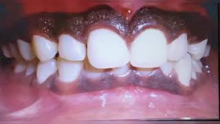 Gingival Pigmentation by dr Alka khade [upl. by Ecyaj]